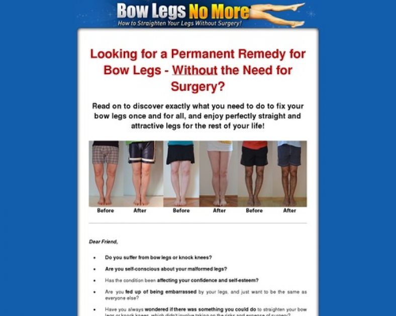 Bow Legs No More – How to Straighten Your Legs Without Surgery!